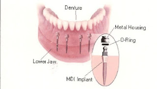 Quy trình cấy ghép Mini – Implant tại nha khoa KIM