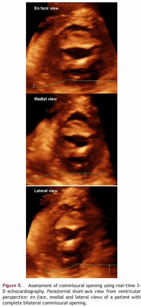 Assessment of commissural opening using echocardiography in mitral stenosis 