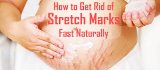 how to get rid of stretch marks naturally