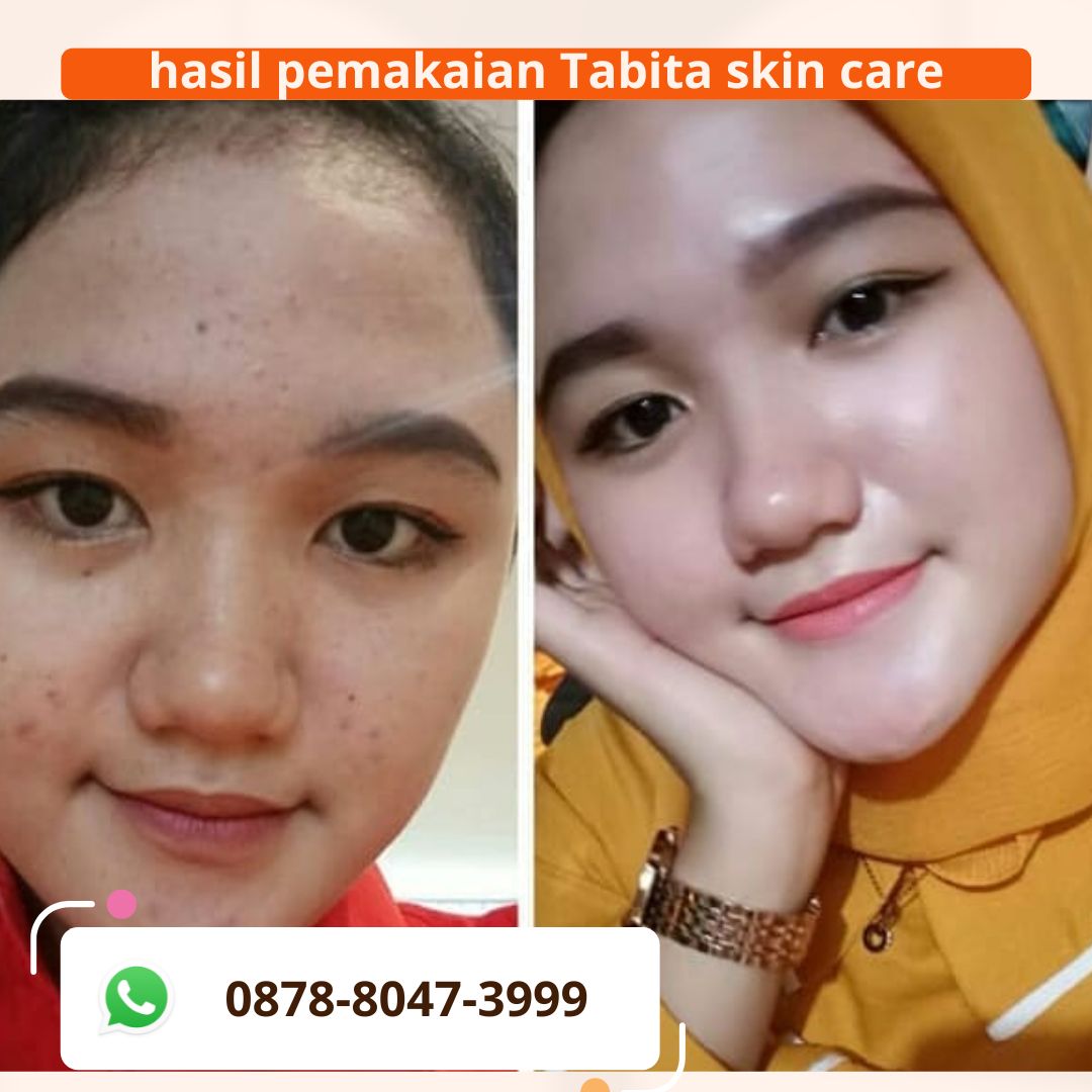 Hasil Pemakaian Tabita Skin Care