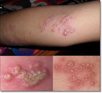 Cara Mengobati Penyakit Kulit Herpes Secara Alami Sampai Tuntas