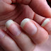 Nails - Fingernails and Toenails
