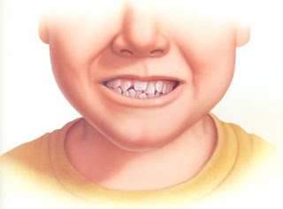 Niềng răng cho trẻ em-1