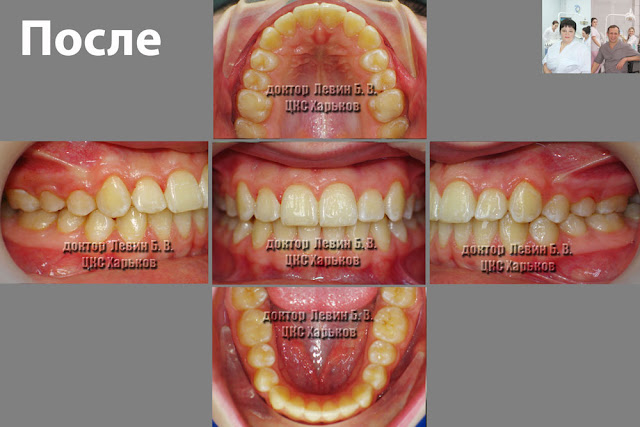 пять фото пациента в разных ракурсах после ортодонтического лечения