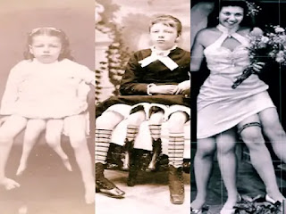 This is a true story of Myrtle Corbin, the 4 legged woman from Texas.
