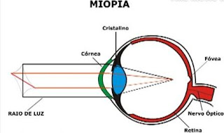 miopia e astigmatismo, o que e astigmatismo, astigmatismo e miopia juntos, astigmatismo e miopia tem cura, hipermetropia e astigmatismo juntos, astigmatismo miópico, miopia o que é, astigmatismo sintomas, astigmatismo infantil