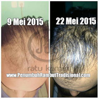 jual obat penumbuh rambut botak herbal ratu kemiri di manado 087823381610