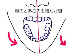 ©さんがつの歯科矯正を始めます　歯並びのイラスト