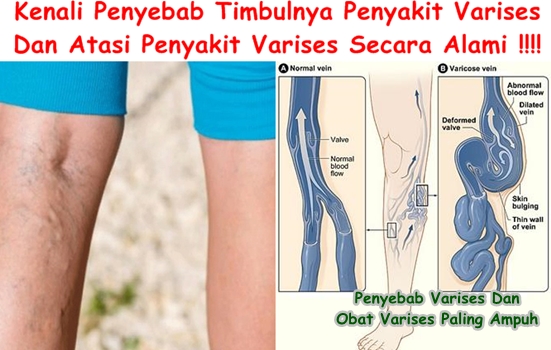 Penyebab Varises Dan Obat Varises Paling Ampuh