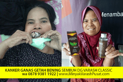 Minyak Varash Obat Kelenjar Getah Bening pada Mulut 