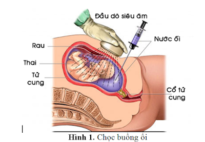 Choc+buong+oi-tham+do+san+khoa