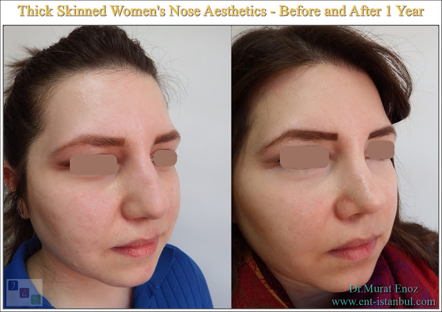 thick skinned nose job,Rhinoplasty for oily round nose,Ethnic nose aesthetic,Before and 1 year after female rhinoplasty,