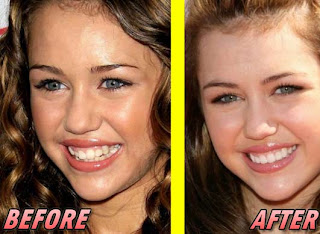 miley cyrus veneers