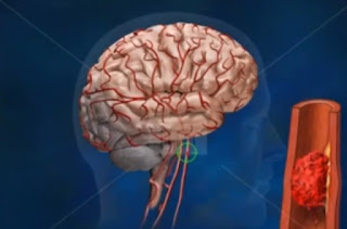 pertolongan pertama pada stroke