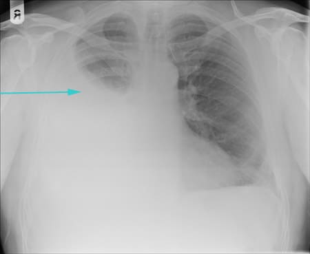 آشعة عادية X-ray على الرئة توضح ارتشاح بللوري (مياه على الرئة اليمنى)