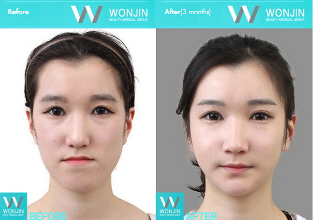 짱이뻐! - Before and After Photos Korean Face Contouring