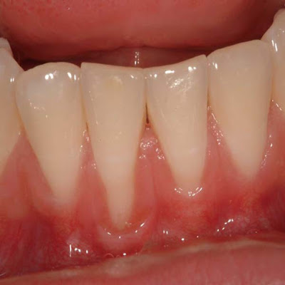 Niềng răng bị sưng lợi khắc phục ra sao?