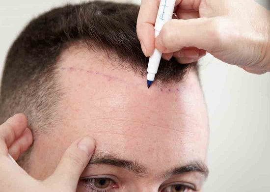 Best Hair Transplant Clinic In Mumbai 