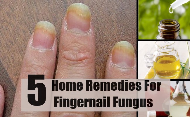 The Top 5 natural ways to get rid of toe nail fungus ...