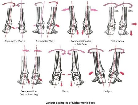 Yiquan, Zhan Zhuang to correct disharmonic feet