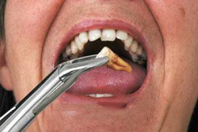 Nhổ răng số 7 hàm trên có nguy hiểm không