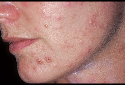 yeast infection on the face