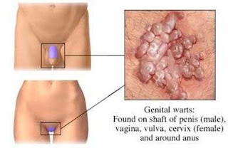 Ciri-Ciri Kutil Kelamin Pada Pria Dan Wanita