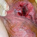 Pengobatan Herbal Wasir dan Ambeyen thumbnail