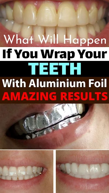 How to Whiten your Teeth Overnight at Home | Wrap Teeth in Aluminum Foil