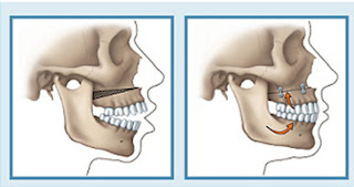 Phẫu thuật chỉnh hình xương hàm