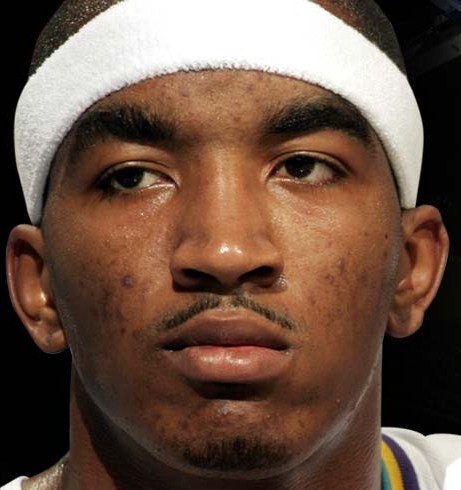 J R Smith battles acne breakouts on much of his face including his cheeks