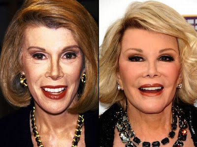 Celebrity Plastic Surgery Before and After