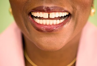 photo_of_gap_between_front_teeth