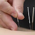 Everything You Should Know About Acupuncture