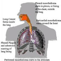 Mesothelioma and asbestos