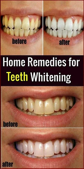 Best Home Remedies for Teeth Whitening