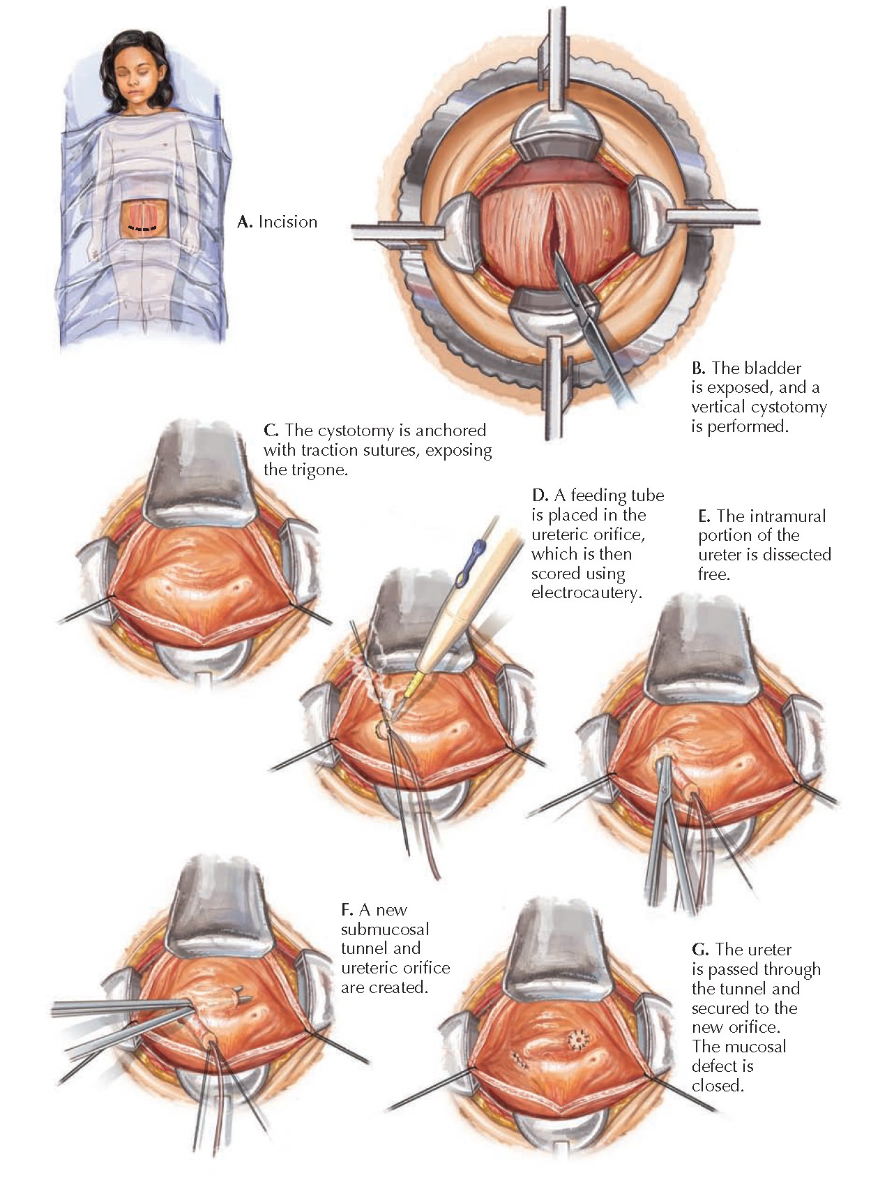 URETERAL REIMPLANTATION