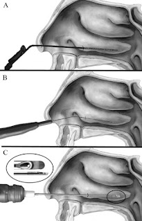 Methods for turbinoplasty