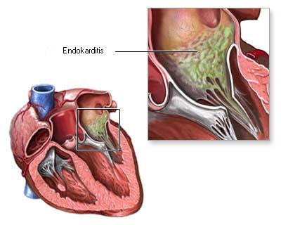 Endokarditis