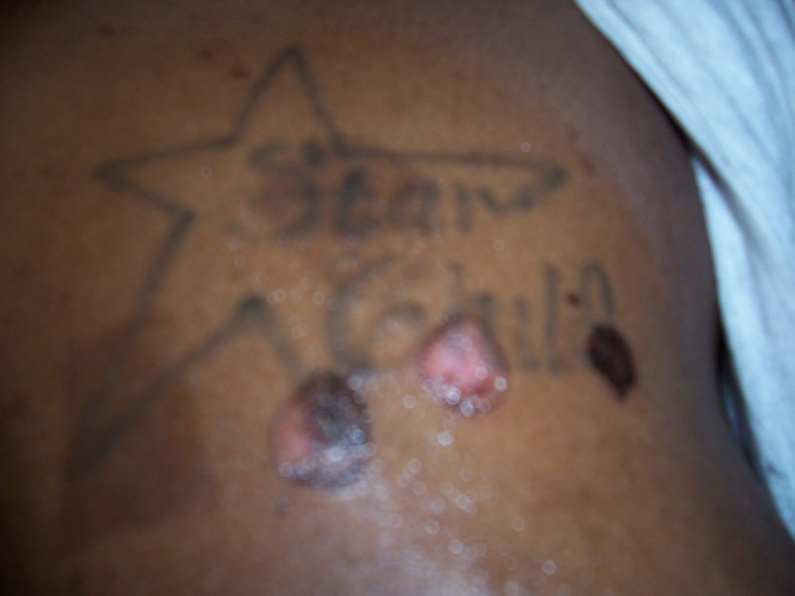Tattoo removal 4-27-2010