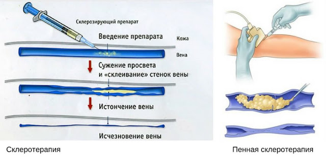 Склеротерапия вен в Одессе