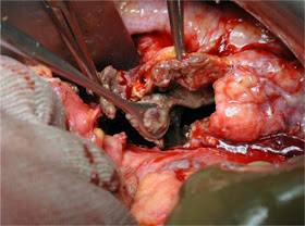 bulimia, acute pancreatitis