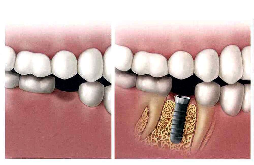 Dental Implants