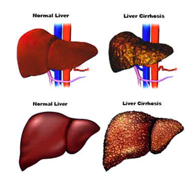 Liver cirrhosis: Symptoms, Causes, Prevention and Treatment.