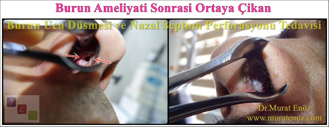 Nazal septum perforasyonu - Septum perforasyonu ameliyatı olanlar - Septum perforasyonu olanlar - Septum perforasyonu ameliyatı yapan doktorlar - Burunda delik oluşumu - Burun duvarında delik - Burun kıkırdak delinmesi tedavisi - Septum perforasyonu ameliyatı olanlar - Septum perforasyonu olanlar - Septal perforasyon tamiri - Septal buton uygulaması - Nazal septum perforasyonu tedavisi - Nazal septum perforasyonu nedenleri - Nazal septum perforasyonu belirtileri - Septum perforasyonun cerrahi onarımı - Burun delinmesinin nedenleri - Nazal septum perforasyonu tanısı - Erkek burun estetiği - Burun estetiği ameliyatı - Definition of Nasal Septal Perforation - Causes of Perforated Nasal Septum - Symptoms of Nasal Septal Perforation - Diagnosis of Nasal Septal Perforation - Surgical Treatment For Nasal Septal Perforation - Nasal Septal Perforation Repair - Surgical Repair of Nasal Septal Perforation - Burun Ucu Düşmesi