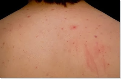 How to Get Rid of Back Acne Home Remedies