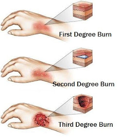cara merawat luka bakar dengan mebo mederma