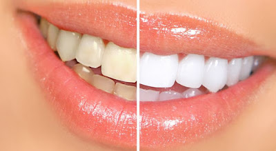 teeth whitening home remedy