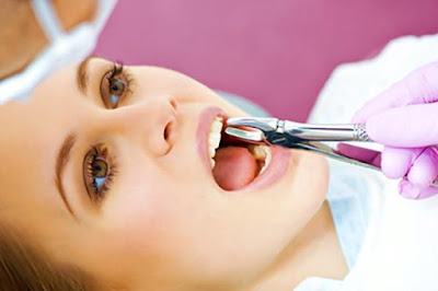 Răng bị vỡ có nên nhổ không?