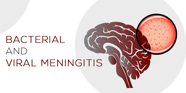Bacterial and Viral Meningitis Know the Differences